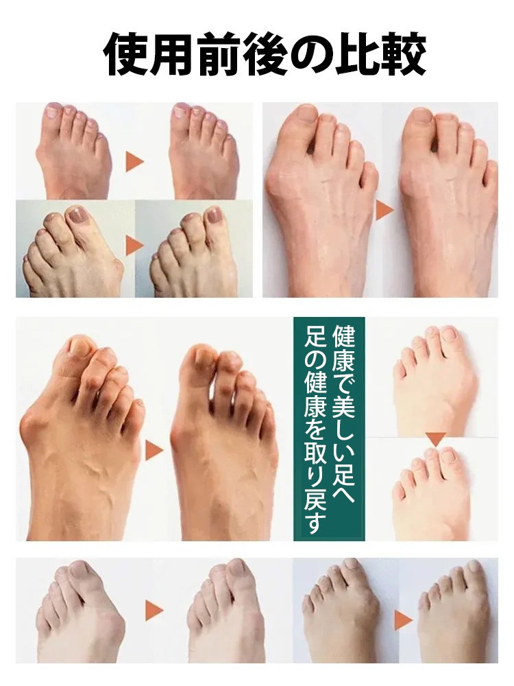 【整形外科医推奨、3日で外反母趾を徹底改善！】外反母趾サポーター